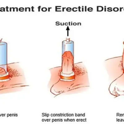 Penis Pump for Men – Vacuum Erection Support Device